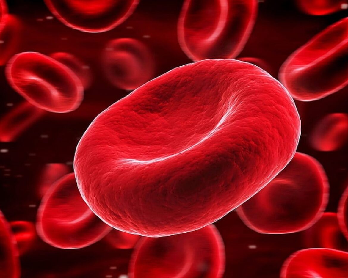 anemia