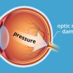 Glaucoma - A Silent Thief of Eyes.