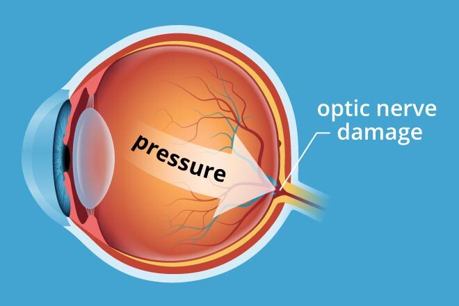 glaucoma-pressure-330×220@2x